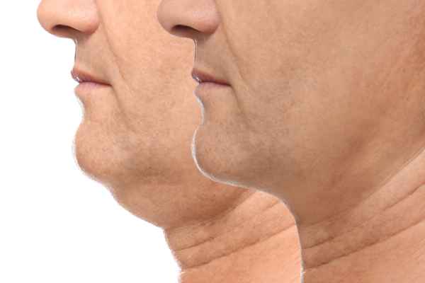 HIFU - Breakthrough in Anti - ageing 2 hifu results Horley
