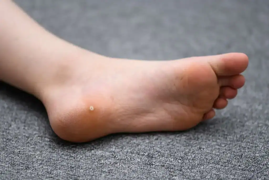 Cryotherapy For Warts And Also Verrucas 2 Image of verruca on the bottom of the foot that able to be treated with Cryotherapy Horley