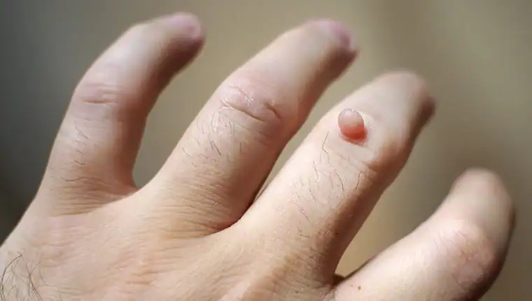 Cryotherapy For Warts And Also Verrucas 1 Image of blemish that Cryotherapy Horley can remove with Lipo 360.