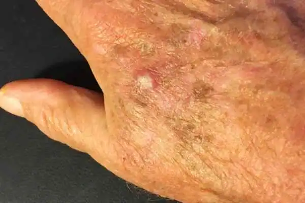 Image of Actinic keratoses Horley on a person hand