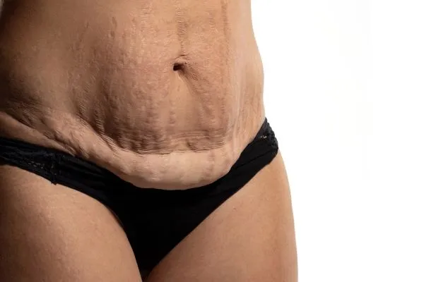 The science behind skin tightening Horley picture of a woman's sagging skin on the stomach